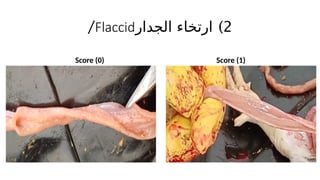 )2
‫الجدار‬ ‫ارتخاء‬
Flaccid
/
Score (0) Score (1)
 