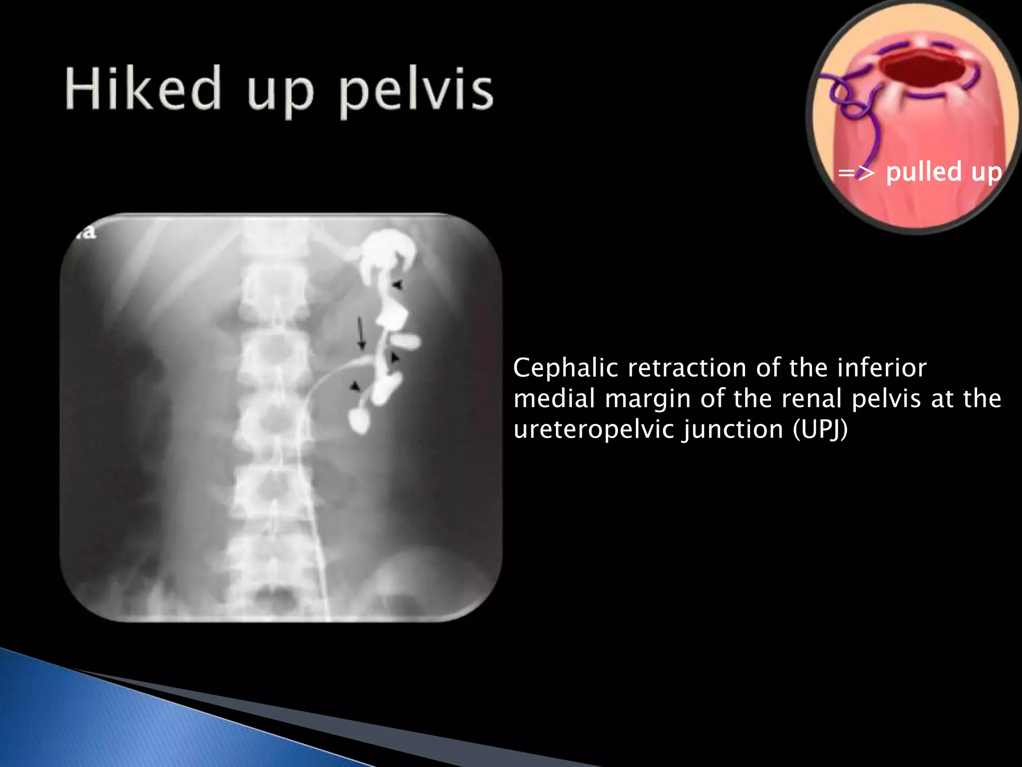 => pulled up 
Cephalic retraction of the inferior 
medial margin of the renal pelvis at the 
ureteropelvic junction (UPJ) 
 