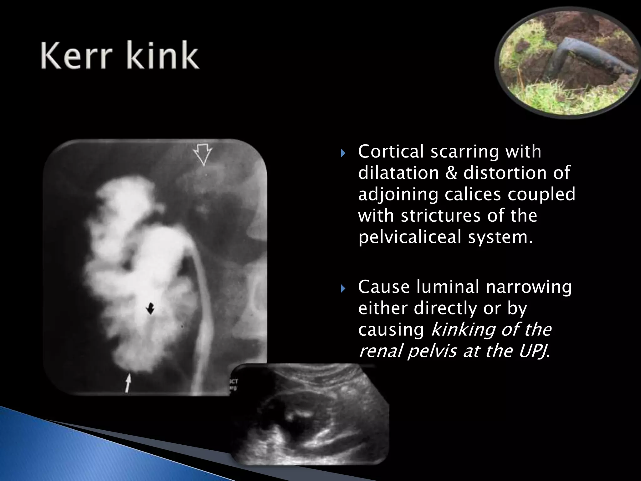  Cortical scarring with 
dilatation & distortion of 
adjoining calices coupled 
with strictures of the 
pelvicaliceal system. 
 Cause luminal narrowing 
either directly or by 
causing kinking of the 
renal pelvis at the UPJ. 
 