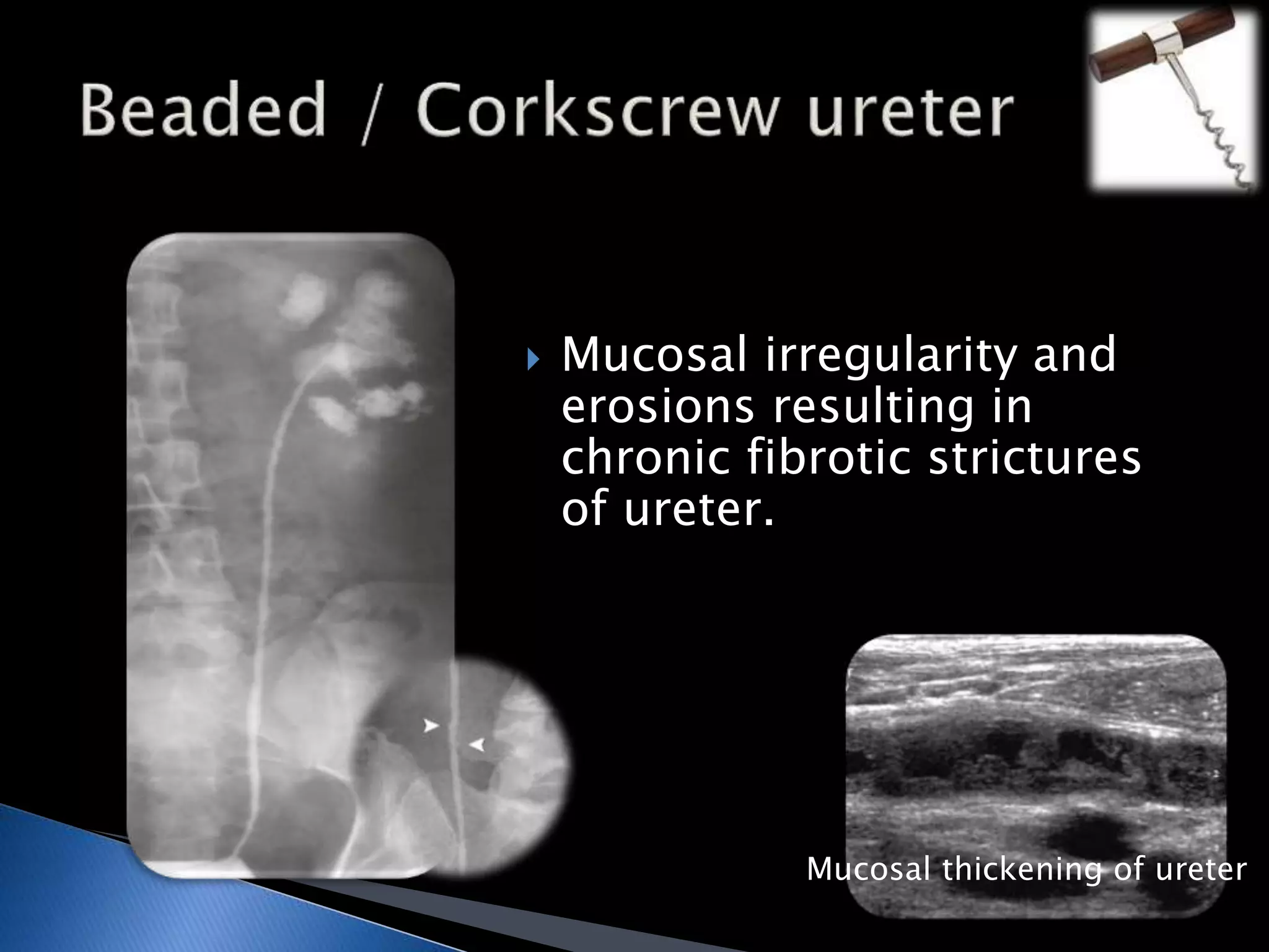  Mucosal irregularity and 
erosions resulting in 
chronic fibrotic strictures 
of ureter. 
Mucosal thickening of ureter 
 