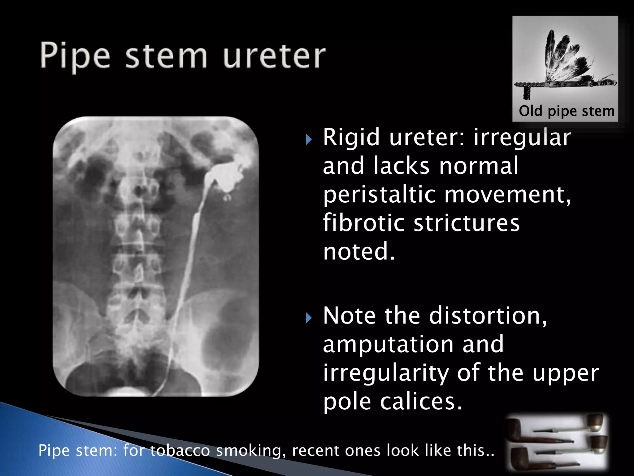  Rigid ureter: irregular 
and lacks normal 
peristaltic movement, 
fibrotic strictures 
noted. 
 Note the distortion, 
amputation and 
irregularity of the upper 
pole calices. 
Pipe stem: for tobacco smoking, recent ones look like this.. 
Old pipe stem 
 