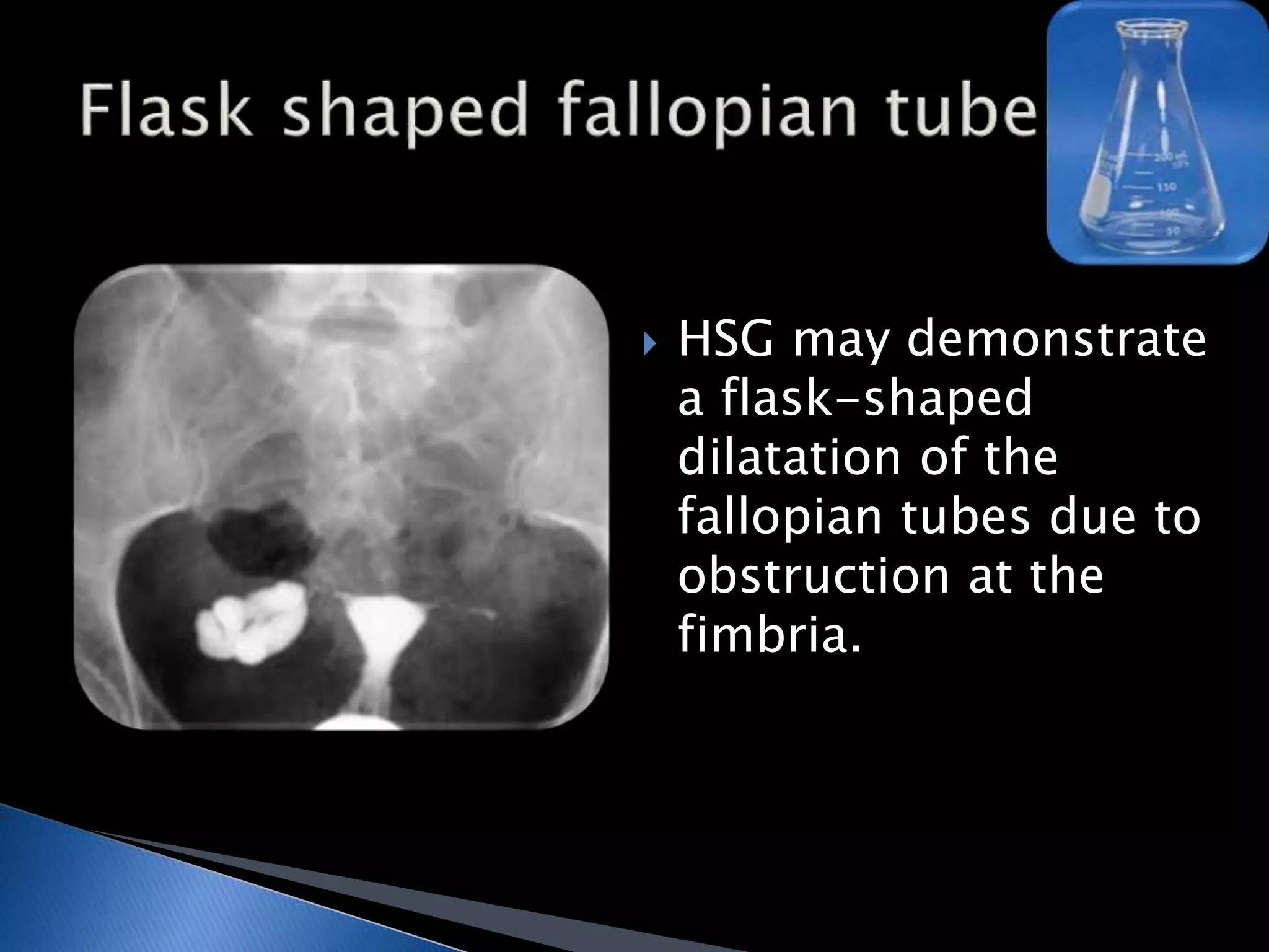 HSG may demonstrate 
a flask-shaped 
dilatation of the 
fallopian tubes due to 
obstruction at the 
fimbria. 
 