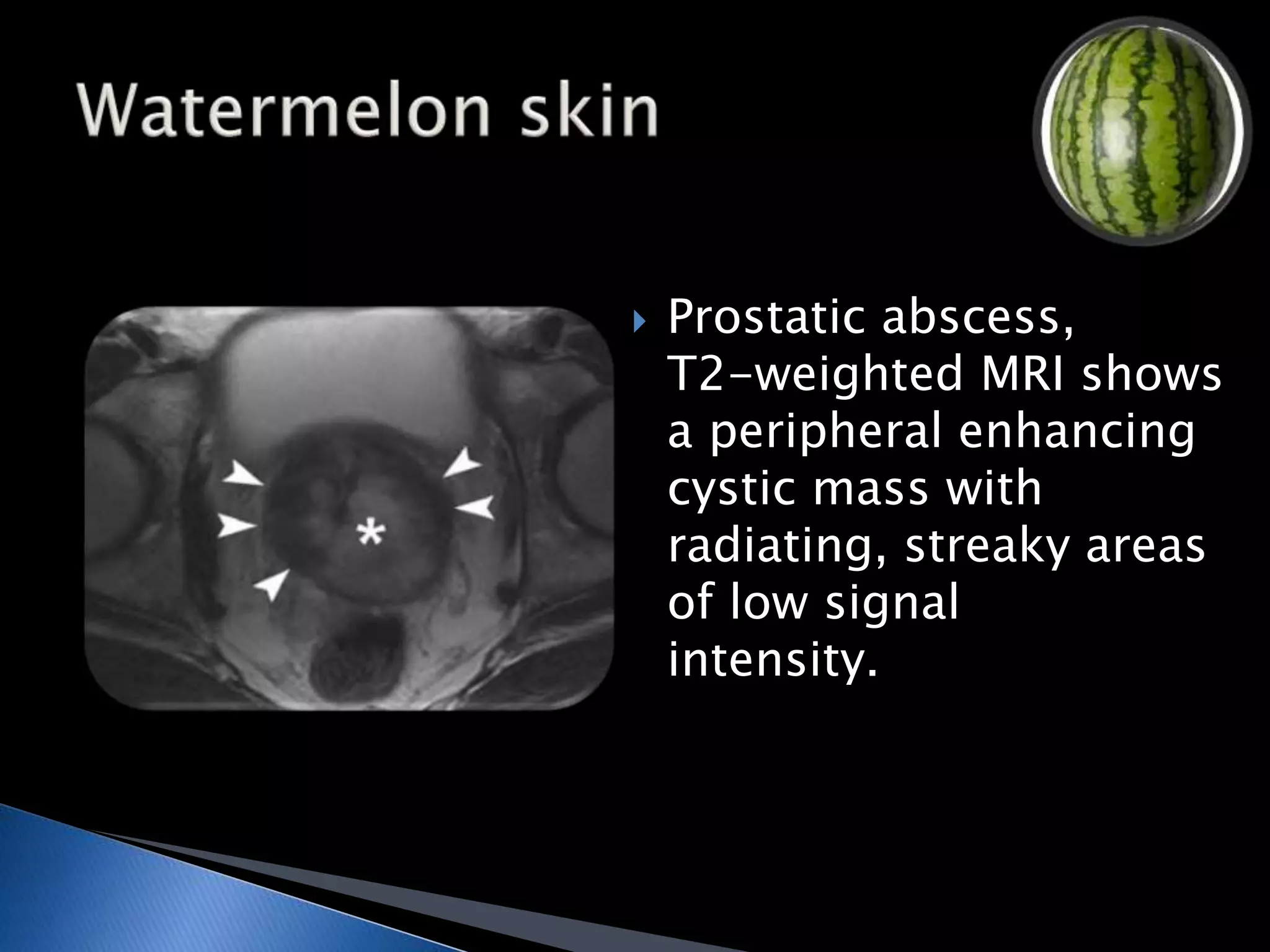  Prostatic abscess, 
T2-weighted MRI shows 
a peripheral enhancing 
cystic mass with 
radiating, streaky areas 
of low signal 
intensity. 
 
