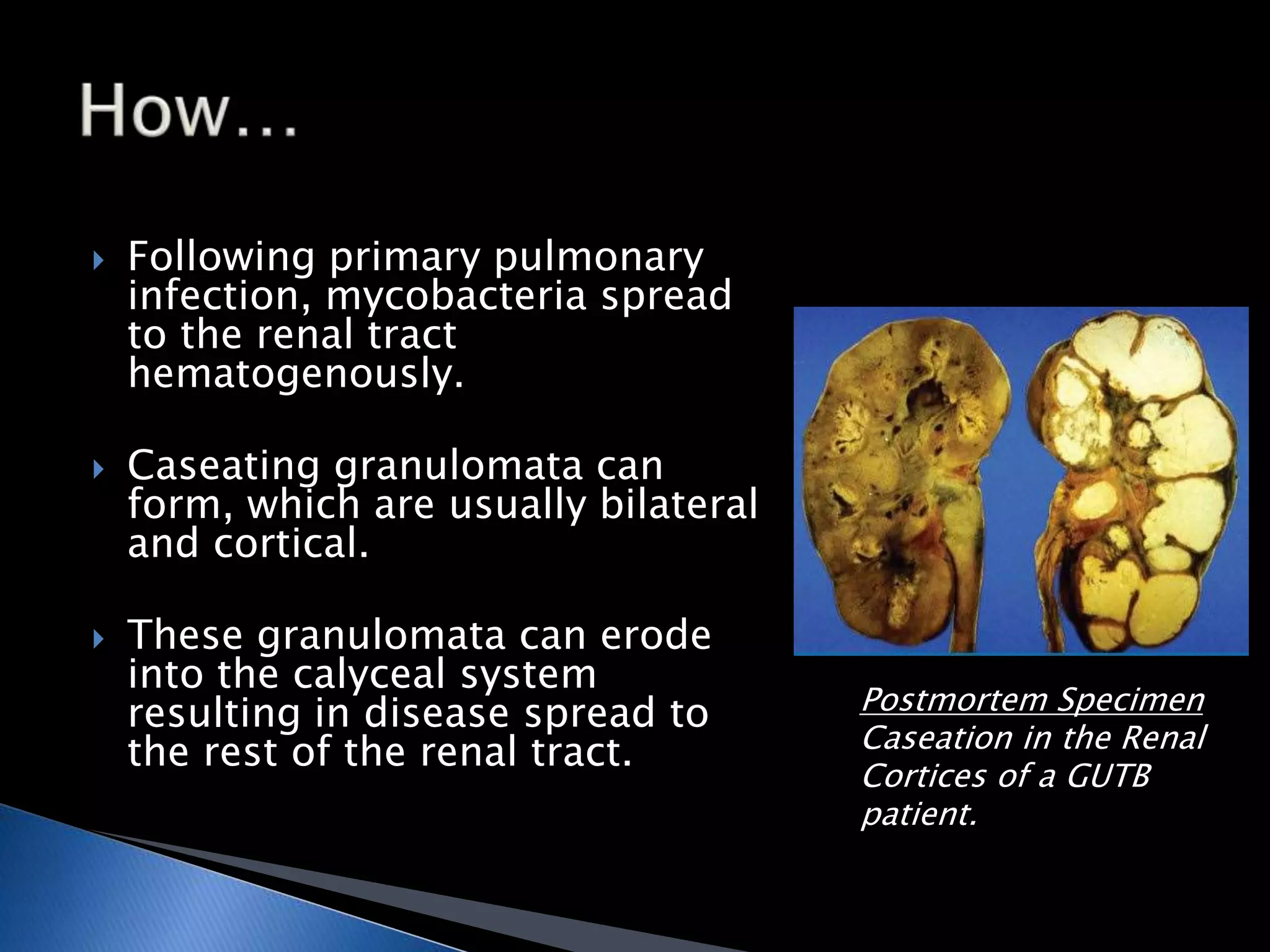  Following primary pulmonary 
infection, mycobacteria spread 
to the renal tract 
hematogenously. 
 Caseating granulomata can 
form, which are usually bilateral 
and cortical. 
 These granulomata can erode 
into the calyceal system 
resulting in disease spread to 
the rest of the renal tract. 
Postmortem Specimen 
Caseation in the Renal 
Cortices of a GUTB 
patient. 
 