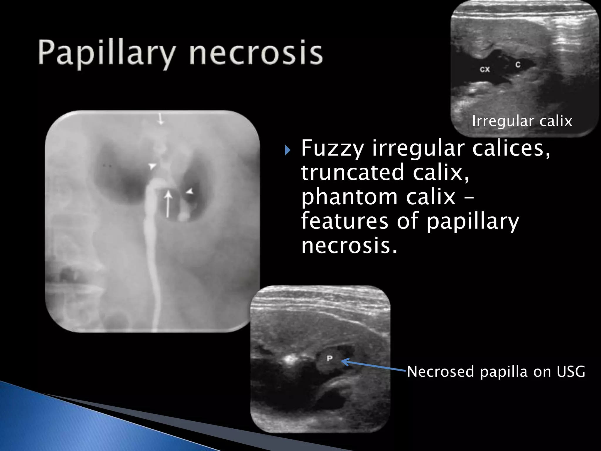 Irregular calix 
 Fuzzy irregular calices, 
truncated calix, 
phantom calix – 
features of papillary 
necrosis. 
Necrosed papilla on USG 
 