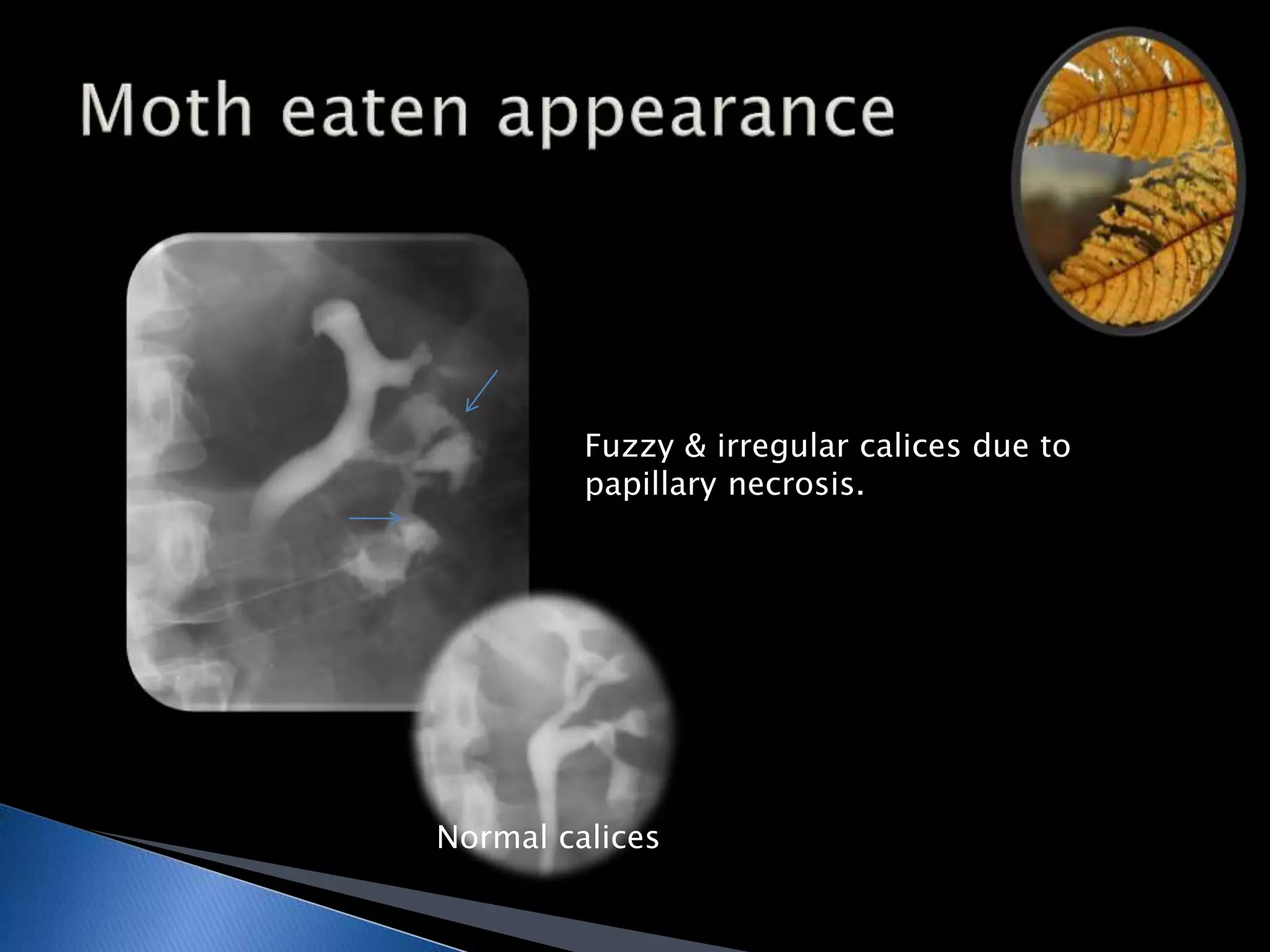 Fuzzy & irregular calices due to 
papillary necrosis. 
Normal calices 
 