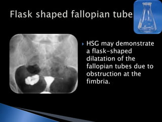 Multiple constrictions 
along the course of 
fallopian tube on 
HSG due to fibrotic 
strictures. 
 