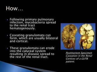  Following primary pulmonary 
infection, mycobacteria spread 
to the renal tract 
hematogenously. 
 Caseating granulomat...