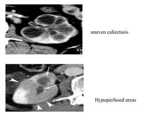 Caliectasis Gutb | PPT