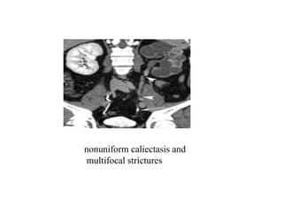 Caliectasis Gutb | PPT