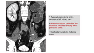 Genito urinary tuberculosis ppt download | PPTX