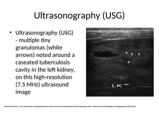 Caseated GUTB FINAL urology presentation ppt .ppt