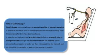 What is Gastric Lavage?
Gastric lavage, commonly known as stomach washing or stomach pumping,
is a medical procedure used to remove poisonous substances or drugs from
the stomach after they have been swallowed.
It is performed by inserting a large-bore tube (called an orogastric tube or
nasogastric tube) through the mouth or nose into the stomach. Small
amounts of warm saline or water are then introduced into the stomach and
suctioned back repeatedly to wash out the stomach contents.
 