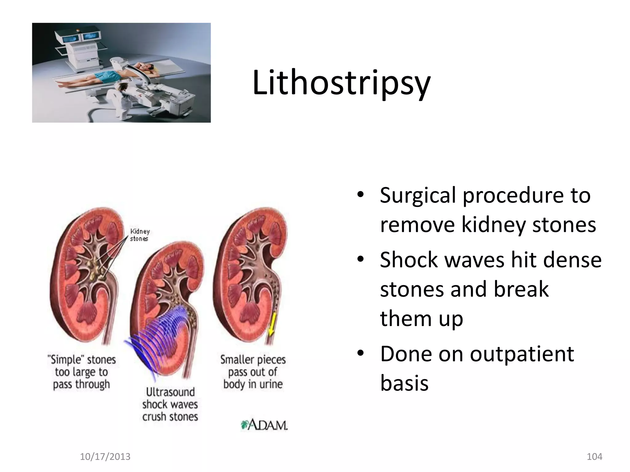 Lithostripsy
• Surgical procedure to
remove kidney stones
• Shock waves hit dense
stones and break
them up
• Done on outpatient
basis
10/17/2013

104

 