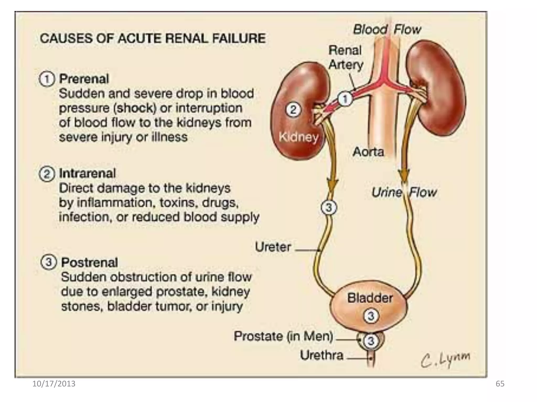 Acute Renal Failure
• Causes
– Prerenal
• Hypovolemia, shock, blood loss, embolism, pooling of fluid d/t
ascites or burns, cardiovascular disorders, sepsis

– Intrarenal
• Nephrotoxic agents, infections, ischemia and blockages, polycystic
kidney disease

– Postrenal
• Stones, blood clots, BPH, urethral edema from invasive procedures

10/17/2013

65

 