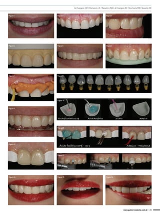 Archangelo CM / Romanini JC / Nesello JNG / Archangelo KC / Anchieta RB / Nesello DG

Figura 1

Figura 2

Figura 3

Figura 4

Figura 5

Figura 6

Figura 7

Figura 8

Figura 10

Figura 9

Figura 11

Figura 12

Figura 13

Figura 14

Figura 15

Figura 16

www.gutierreodonto.com.br > 25

 