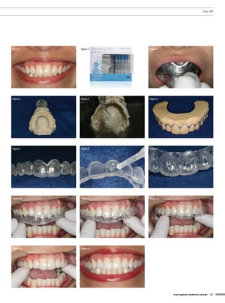 Palo RM

Figura 1

Figura 2

Figura 3

Figura 4

Figura 5

Figura 6

Figura 7

Figura 8

Figura 9

Figura 10

Figura 11

Figura 12

Figura 13

Figura 14

www.gutierreodonto.com.br > 29

 