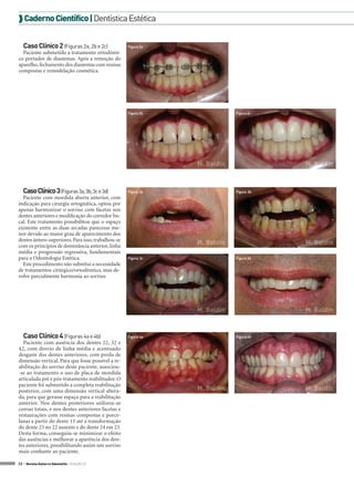  Caderno Científico | Dentística Estética
Caso Clínico 2 (Figuras 2a, 2b e 2c)

Figura 2a

Paciente submetido a tratamento ortodôntico portador de diastemas. Após a remoção do
aparelho, fechamento dos diastemas com resinas
compostas e remodelação cosmética.

M. Baldin
Figura 2b

Figura 2c

M. Baldin

Caso Clínico 3 (Figuras 3a, 3b, 3c e 3d)
Paciente com mordida aberta anterior, com
indicação para cirurgia ortognática, optou por
apenas harmonizar o sorriso com facetas nos
dentes anteriores e modificação do corredor bucal. Este tratamento possibilitou que o espaço
existente entre as duas arcadas parecesse menor devido ao maior grau de aparecimento dos
dentes ântero-superiores. Para isso, trabalhou-se
com os princípios de dominância anterior, linha
média e progressão regressiva, fundamentais
para a Odontologia Estética.
Este procedimento não substitui a necessidade
de tratamentos cirúrgico/ortodôntico, mas devolve parcialmente harmonia ao sorriso.

Figura 3a

M. Baldin

Figura 3b

M. Baldin
Figura 3c

M. Baldin
Figura 3d

M. Baldin

Caso Clínico 4 (Figuras 4a e 4b)
Paciente com ausência dos dentes 22, 32 e
42, com desvio de linha média e acentuado
desgaste dos dentes anteriores, com perda de
dimensão vertical. Para que fosse possível a reabilitação do sorriso deste paciente, associou-se ao tratamento o uso de placa de mordida
articulada pré e pós-tratamento reabilitador. O
paciente foi submetido a completa reabilitação
posterior, com uma dimensão vertical alterada, para que gerasse espaço para a reabilitação
anterior. Nos dentes posteriores utilizou-se
coroas totais, e nos dentes anteriores facetas e
restaurações com resinas compostas e porcelanas a partir do dente 13 até a transformação
do dente 23 no 22 ausente e do dente 24 em 23.
Desta forma, conseguiu-se minimizar o efeito
das ausências e melhorar a aparência dos dentes anteriores, possibilitando assim um sorriso
mais confiante ao paciente.
32 > Revista Gutierre Odontolife - EDIÇÃO 57

Figura 4a

M. Baldin

Figura 4b

M. Baldin

M. Baldin

 