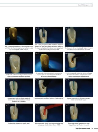 Alves MR / Junqueira Jr. AA

Figura 1

Após o tratamento endodôntico é feita a remoção do material obturador. No mínimo a mesma medida coronária
e no máximo 2/3 do conduto radicular.
Figura 3b

Certificando-se do travamento procedemos ao corte
incial no comprimento de trabalho necessário.
Figura 5

Para a secagem pode ser utilizado sugador de
endo ou peças plásticas adaptadas à cânula
(Cappilary Tips - Ultradent).
Figura 8

Finalização da secagem com cone de papel.

Figura 2

Após a remoção, o preparo é feito com brocas do mesmo
diâmetro dos pinos com o objetivo de máxima adaptação.
O instrumento final é escolhido de acordo com a amplitude
da obturação final diagnosticada pelo RX.
Figura 3c

Em casos onde o elemento apresenta remanescente
coronário, pode ser necessário o corte chanfrado
do pino para melhor adaptação.
Figura 6

Condicionamento com Ácido Fosfórico a 37% durante 15s.

Figura 9

Aplicação ativa do adesivo com movimentos vigorosos
contra a superfície dentinária. (Allcem - FGM).

Figura 3a

Certificamos o diâmetro e adaptação do pino. O mesmo
deve "travar"nas paredes internas do conduto.
Figura 4

O início do preparo do conduto faz-se com a utilização
de insertos ultrassônicos sem ponta ativa com o
objetivo de limpeza sem desgaste interno.
Figura 7

Lava-se novamente com ultrassom e secagem
inicial com cânulas de sucção.

Figura 10

Remoção do excesso de adesivo com cones
de papel. Deixar por 15s dentro do canal.
www.gutierreodonto.com.br > 35

 