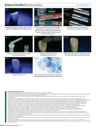  Caderno Científico | Dentística Estética
Figura 11

Figura 12

Fotopolimerização por 40s. Verificar a potência do fotopolimerizador. (Optilight Max, 1200 mW/cm2, Gnatus).

Preparo prévio do Pino: Aplicação de ácido fosfórico
por 40s, lavagem e secagem. Aplicação do silano e
aguardar 3 min para evaporação. Aplicação do adesivo,
secagem com jato de ar para remoção de excessos
e fotopolimerização por 15s.

Figura 14

Figura 15

Verificar dispositivo intra-canal que acompanha
a ponta automix do sistema.
Figura 17

Alves MR / Junqueira Jr. AA

Figura 13

Cimentação e restauração coronária feita com
cimento resinoso dual (Allcem Core, FGM).

Figura 16

Inserção do cimento dentro do canal
previamente à inserção do pino.

Aspecto final, notar a cobertura completa do remanescente. Não é indicado deixar o pino de fibra exposto.

Figura 18

Fotopolimerização por 40s.

Polimento pode ser feito com discos de lixa e feltro acompanhados de pastas de polimento (Diamond master, FGM).

◗◗ REFERÊNCIAS BIBLIOGRÁFICAS
1) Sedgley CM, Messer HH. Are endodontically treated teeth more brittle? J Endod. 1992 Jul;18(7):332-5.
2) González-Lluch C, Rodríguez-Cervantes PJ, Sancho-Bru JL, Pérez-González A, Barjau-Escribano A, Vergara-Monedero M, Forner-Navarro L. Influence of material and diameter of pre-fabricated
posts on maxillary central incisors restored with crown. J Oral Rehabil. 2009 Oct;36(10):737-47.
3) Santos-Filho PC, Castro CG, Silva GR, Campos RE, Soares CJ. Effects of post system and length on the strain and fracture resistance of root filled bovine teeth. Int Endod J. 2008
Jun;41(6):493-501.
4) Braga NM, Paulino SM, Alfredo E, Sousa-Neto MD, Vansan LP. Removal resistance of glass-fiber and metallic cast posts with different lengths. J Oral Sci. 2006 Mar;48(1):15-20.
5) D'Arcangelo C, Cinelli M, De Angelis F, D'Amario M. The effect of resin cement film thickness on the pullout strength of a fiber-reinforced post system. J Prosthet Dent. 2007 Sep;98(3):193-8.
6) Teixeira CS, Silva-Sousa YT, Sousa-Neto MD. Bond strength of fiber posts to weakened roots after resin restoration with different light-curing times. J Endod. 2009 Jul;35(7):1034-9.
7) De-Deus G, Murad C, Paciornik S, Reis CM, Coutinho-Filho T. The effect of the canal-filled area on the bacterial leakage of oval-shaped canals. Int Endod J. 2008 Mar;41(3):183-90.
8) Grandini S, Goracci C, Monticelli F, Borracchini A, Ferrari M. SEM evaluation of the cement layer thickness after luting two different posts. J Adhes Dent. 2005 Autumn;7(3):235-40.
9) Grandini S, Sapio S, Simonetti M. Use of anatomic post and core for reconstructing an endodontically treated tooth: a case report. J Adhes Dent. 2003 Fall;5(3):243-7.
10) Faria-e-Silva AL, Pedrosa-Filho Cde F, Menezes Mde S, Silveira DM, Martins LR. Effect of relining on fiber post retention to root canal. J Appl Oral Sci. 2009 Nov-Dec;17(6):600-4.
11) Naumann M, Sterzenbach G, Rosentritt M, Beuer F, Frankenberger R. Is adhesive cementation of endodontic posts necessary? J Endod. 2008 Aug;34(8):1006-10.
12) Bergman B, Lundquist P, Sjogren U, Sundquist G. Restorative and endodontic results after treatment with cast posts and cores. J Prosthet Dent. 1989 jan;61(1) 10-5.
13) Mentink AG, Meeuwissen R, Kayser AF, Mulder J. Survival rate and failure characteristics of the all metal post and core restoration. J Oral Rehabil. 1993 Sep;20(5) 455-61.
14) Stockton LW. Factors affecting retention of post systems: a literature review. J Prosthet Dent. 1999 Apr;81(4):380-5.
15) Stewardson D, Shortall A, Marquis P. The bond of different post materials to a resin composite cement and a resin composite core material. Oper Dent. 2012 Nov-Dec;37(6):E1-12.
16) Shori D, Pandey S, Kubde R, Rathod Y, Atara R, Rathi S. To evaluate and compare the effect of different Post Surface treatments on the Tensile Bond Strength between Fiber Posts and
Composite Resin. J Int Oral Health. 2013 Oct;5(5):27-32.
17) Daleprane B, Nemesio de Barros Pereira C, Oréfice R, Bueno A, Vaz R, Moreira A, Magalhães C. The Effect of Light-curing Access and Different Resin Cements on Apical Bond Strength of
Fiber Posts. Oper Dent. 2013 Oct 22.
18) D’Arcangelo C, D’Amario M, De Angeles F, Zazzeroni S, Vadini M, Caputi S. Effect of application technique of luting agent on the retention of three types of fiber-reinforced post systems. J
Endod 2007;33:1378-82.
19) D’Arcangelo C, D’Amario M, Vadini M, Zazzeroni S, De Angeles F, Caputi S. An evaluation of luting agent application technique effect on fibre post retention. J Dent 2008;36:235-40.
20) Shiratori FK, Valle AL, Pegoraro TA, Carvalho RM, Pereira JR. Influence of technique and manipulation on self-adhesive resin cements used to cement intraradicular posts. J Prosthet Dent.
2013 Jul;110(1):56-60.
36 > Revista Gutierre Odontolife - EDIÇÃO 57

 