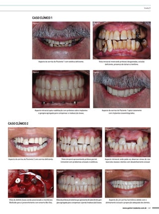 Inada E

CASO CLÍNICO 1
Figura 1

Figura 2

Vista intraoral mostrando próteses desgastadas, oclusão
deficiente, presença de tártaro e biofilme.

Aspecto do sorriso do Paciente 1 com estética deficiente.

Figura 3

Figura 4

Aspecto intraoral após reabilitação com próteses sobre implantes
e gengiva agregada para compensar a reabsorção óssea.

Aspecto do sorriso do Paciente 1 após tratamento
com implantes osseointegrados.

CASO CLÍNICO 2
Figura 5

Aspecto do sorriso da Paciente 2 com sorriso deficiente.

Figura 8

Vista do defeito ósseo sendo posicionado a membrana
BioGuide para o preenchimento com enxerto Bio-Oss.

Figura 6

Vista intraoral apresentando prótese parcial
removível com problemas oclusais e estéticos.

Figura 9

Vista da prótese provisória que apresenta do lado direito gengiva agregada para compensar a perda (reabsorção) óssea.

Figura 7

Aspecto intraoral onde pode-se observar áreas de reabsorções ósseas e dentes com desalinhamento oclusal

Figura 10

Aspecto de um sorriso harmônico obtido com o
alinhamento oclusal e proporção adequada dos dentes.
www.gutierreodonto.com.br > 41

 