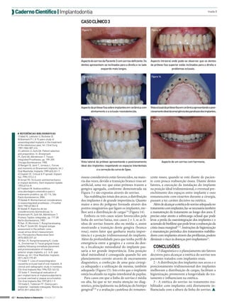 Caderno Científico | Implantodontia

Inada E

CASO CLÍNICO 3
Figura 11

Aspecto do sorriso da Paciente 3 com sorriso deficiente. Os
dentes apresentam-se inclinados para a direita e no lado
esquerdo mais longos.
Figura 13

Aspecto da prótese fixa sobre implantes em cerâmica com
alinhamento e a oclusão reestabelecida.
Figura 15

◗◗ REFERÊNCIAS BIBLIOGRÁFICAS
1) Adell R, Lekholm U, Rockeler B,
Brånemark P-I. A 15 years study of
osseointegrated implants in the treatment
of the edentulous jaws. Int J Oral Surg
1981;10(6):387-416.
2) Lekholm U, Zarb GA. Patient selection
and preparation. In: Branemark
PI, Zarb GA, Albrektsson T. TissueIntegrated Prostheses. pp. 199-209.
Chicago:Quintessence, 1985.
3) Rangert B, Jemt T, Jorneus L. Forces
and moments on Branemark implants. Int J
Oral Maxillofac Implants 1989;4(3):241-7.
4) English CE. Critical A-P spread. Implant
Soc.1990;1(1):2-3.
5) Ismail YH. Occlusion and biomechanics
in implant dentistry. Dent Implantol Update
1993;4(1):6-8.
6) Fradeani M. Análise estética:
uma abordagem sistemática para o
tratamento protético. pp. 63-114. São
Paulo:Quintessence, 2006.
7) Skalak R. Biomechanical considerations
in osseointegrated prostheses. J Prosthet
Dent 1983;49:843-8.
8) Skalak R. Aspectos de las
consideraciones biomecánicas. In:
Branemark PI, Zarb GA, Albrektsson T.
Protesis Tejidos-integradas. pp. 117-28.
Berlin:Quintessence, 1987.
9) Kan JY, Morimoto T, Rungcharassaeng
K, Roe P, Smith DH. Gingival biotype
assessment in the esthetic zone:
visual versus direct measurement.
Int J Periodontics Restorative Dent
2010;30(3):237-43
10) Kan JY, Rungcharassaeng K, Lozda
JL, Zimmerman G. Facial gingival tissue
stability following immediate placement
and provisionalization of maxillary
anterior single implants: a 2- to 8- year
follow-up. Int J Oral Maxillofac Implants
2011;26(1):179-87.
11) Isidor F. Loss of osseointegration
caused by occlusal load of oral implants. A
clinical and radiographic study in monkeys.
Clin Oral Implants Res 1996;7(2):143-52.
12) Isidor F. Histological evaluation of
peri-implant bone at implantssubjected to
occlusal overload or plaque accumulation.
Clin Oral Implants Res 1997;8(1):1-9.
13) Inada E, Todescan FF. Doença periimplantar: realidade indesejada. Revista da
APCD 2011;65(4):252-7.
42 > Revista Gutierre Odontolife - EDIÇÃO 57

Figura 12

Aspecto intraoral onde pode-se observar que os dentes
da prótese fixa superior estão inclinados para a direita e
problemas oclusais.
Figura 14

Vista oclusal da prótese fixa em cerâmica apresentando o posicionamento ideal da emergência dos parafusos dos implantes.
Figura 16

Vista lateral da prótese apresentando o posicionamento
ideal dos implantes respeitando os espaços interdentais
e a correção da curva de Spee.

Aspecto de um sorriso com harmonia.

ósseas consideráveis estão favorecidos, na maioria das vezes, devido a transição branco rosa ser
artificial, uma vez que estas próteses trazem a
gengiva agregada, conforme demonstrada na
Figura 3 e são expostas através do sorriso.
Nas reabilitações totais dos arcos, a distribuição
dos implantes é de grande importância. Quanto
maior a área do polígono formada através dos
pontos imaginários que ligam os implantes, melhor será a distribuição de cargas7,8 (Figura 14).
Embora os três casos sejam favorecidos pela
linha do sorriso baixa, nos casos 2 e 3, se as linhas de sorriso fossem alta ou média e, assim
mostrando a transição dente gengiva (branco
rosa), outro fator que ganharia muita importância é a posição tridimensional do implante.
Além da profundidade para que tenha perfil de
emergência entre a gengiva e a coroa do dente, a localização mésiodistal do implante passaria a ter grande importância. Esta posição
ideal mésiodistal é conseguida quando há um
planejamento correto através de enceramento
diagnóstico, a confecção de uma guia cirúrgica adequada e a utilização da mesma, também
adequada (Figura 15). Isto evita que o implante
esteja localizado na região interdental de papilas.
Para casos em que a linha do sorriso é média
ou alta, há que se ter muita atenção no diagnóstico, principalmente na definição do biótipo
gengival9,10 e a avaliação cautelosa do remanes-

cente ósseo, quando se está diante de paciente com pouca reabsorção óssea. Diante destes
fatores, a execução da instalação do implante
na posição ideal tridimensional, o eventual preenchimento dos espaços entre implante e osso
remanescente com enxertos durante a cirurgia,
passam a ter caráter decisivo na estética.
Além de alcançar a estética do sorriso adequada no
tratamento com implantes, faz-se necessária também
a manutenção do tratamento ao longo dos anos. É
preciso estar atento a sobrecarga oclusal que pode
levar a perda da osseointegração dos implantes e o
acúmulo de biofilme que pode levar a reabsorção da
crista óssea marginal11,12. Instruções de higienização
e manutenção periódica dos tratamentos reabilitadores com implantes através das profilaxias, podem
diminuir o risco às doenças peri-implantares13.

CONCLUSÕES
1 - O diagnóstico e o planejamento são fatores
decisivos para alcançar a estética do sorriso nos
pacientes tratados com implantes orais.
2 - A distribuição dos implantes nos arcos e o
posicionamento tridimensional dos implantes
melhoram a distribuição de cargas, facilitam a
higienização, promovem a longevidade do tratamento e influenciam na estética.
3 - A estética do sorriso no tratamento reabilitador com implantes está diretamente influenciada com a altura da linha do sorriso. 

 