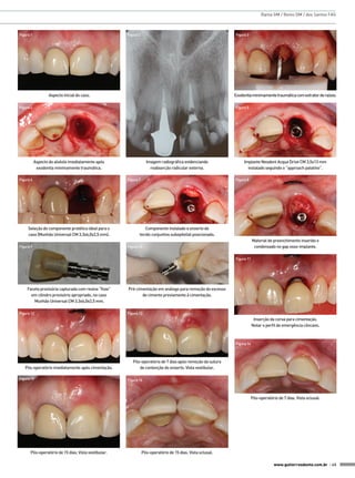 Rama GM / Reino DM / dos Santos FAS

Figura 1

Figura 3

Figura 2

Aspecto inicial do caso.

Exodontia minimamente traumática com extrator de raízes.

Figura 4

Figura 5

Imagem radiográfica evidenciando
reabsorção radicular externa.

Aspecto do alvéolo imediatamente após
exodontia minimamente traumática.
Figura 6

Seleção do componente protético ideal para o
caso (Munhão Universal CM 3.3x6,0x2,5 mm).
Figura 9

Figura 7

Implante Neodent Acqua Drive CM 3,5x13 mm
instalado seguindo o “approach palatino”.
Figura 8

Componente instalado e enxerto de
tecido conjuntivo subepitelial posicionado.
Material de preenchimento inserido e
condensado no gap osso-implante.

Figura 10
Figura 11

Faceta provisória capturada com resina “flow”
em cilindro provisório apropriado, no caso
Munhão Universal CM 3.3x6,0x2,5 mm.
Figura 12

Pré-cimentação em análogo para remoção do excesso
de cimento previamente à cimentação.

Figura 13

Inserção da coroa para cimentação.
Notar o perfil de emergência côncavo.

Figura 14

Pós-operatório imediatamente após cimentação.
Figura 15

Pós-operatório de 7 dias após remoção da sutura
de contenção do enxerto. Vista vestibular.
Figura 16

Pós-operatório de 7 dias. Vista oclusal.

Pós-operatório de 15 dias. Vista vestibular.

Pós-operatório de 15 dias. Vista oclusal.
www.gutierreodonto.com.br > 45

 