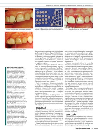 Magalhães D / Naves MM / Menezes NS / Menezes HHM / Magalhães GC / Magalhães FC


Figura 1                                                  Figura 2                                                     Figura 3




                                                         Fragmentos padronizados, retirados da membrana im-
  Aspecto clínico inicial do envolvimento periodontal.   pregnada, a serem utilizados como dispositivo de liberação.              Inserção do “chip” na bolsa periodontal.

Figura 4




              Aspectos clínicos após 21 dias.
                                                         dagem e bolsas periodontais com profundidade                  mais efetivos em sítios localizados, requerendo,
                                                         igual ou superior a 5 mm (Figura 1). Inicialmen-              no entanto, o uso de carreadores para aplica-
                                                         te o paciente foi submetido aos procedimentos                 ção local. Frente a essa possibilidade, estudos
                                                         de raspagem e alisamento radicular por meio de                demonstram a viabilidade das membranas ab-
                                                         curetas tipo Gracey 5/6. Todos os princípios de               sorvíveis de origem bovina de atuarem como
                                                         instrumentação foram observados e, ao final do                sistema matricial para liberação controlada
                                                         procedimento, a superfície radicular apresenta-               desse fármco8.
                                                         va-se plana e regular.                                           Frente a essas características, foi possível a
                                                            Membranas xenógena absorvíveis obtida a                    utilização desse recurso em nosso trabalho.
                                                         partir de osso bovino, utilizada em procedi-                  Obtivemos amostras padronizadas de mem-
    ◗◗ REFERÊNCIAS BIBLIOGRÁFICAS
    1) Van der Ouderaa FJG (1991) Anti-plaque
                                                         mentos regenerativos periodontais (Genderm®                   branas previamente impregnadas e disponi-
    agents. Rationale and prospects for                  - Baumer-Br), foram previamente impregnadas                   bilizadas para o nosso uso. Verificamos que
    prevention of gingivitis and periodontal             por cloridrato de tetraciclina e fornecidas para              os “chips” obtidos a partir dessas membranas,
    disease. J Clin Periodontol, 18;447-454.
    2) Tinoco, EMB, Beldi, MI, Campedelli, F,
                                                         o trabalho. Estas foram recortadas, com um                    apresentavam consistência e dimensões com-
    Lana, M, Loureiro CA, Bellini HT, Rams               bisturi circular de 5 mm de diâmetro sobre um                 patíveis com a sua inserção no interior das
    TE, Tinoco PG, Preus HR. Clinical and                campo estéril, obtendo-se assim “chips” a serem               bolsas, permitindo, assim, o adequado posicio-
    microbiological effects of adjunctive
    antibiotics in treatment of localized juvekine
                                                         instalados no interior da bolsa periodontal, os               namento subgengival. Sem, no entanto, causar
    periodontics. A controlled clinical trial. J.        quais foram armazenados em frasco estéril até                 qualquer tipo de desconforto local ou sistêmico
    periodontal. V.69,n.12,p.1355-1363, 1998.            o momento do seu uso (Figura 2).                              para o paciente ao longo do período avaliado.
    3) Goodson J. Pharmacokinetic principles
    controlling efficacy of oral therapy. J Dent
                                                            Após a raspagem e o alisamento radicular,                  Fato que demonstra ser um recurso tolerável
    Res 1989 68: 1625-32.                                os “chips” foram posicionados subgengival-                    pelo organismo, sem efeitos indesejáveis em
    4) Medlicott, NJ, Rathbone, MJ, Tucker, IG,          mente na face vestibular e palatina/lingual de                nível local ou sistêmico.
    Holborow, DW. Delivery systems for the
    administration of drugs to the periodontal
                                                         cada dente (Figura 3). Em seguida o paciente                     Embora por si só a raspagem e o alisamento
    pocket. Adv. Drug Deliv. Rev., v. 13, p. 181-        foi orientado quanto aos cuidados de higiene                  radicular determinem uma redução da atividade
    203, 1994.                                           bucal e liberado, retornando após 21 dias para                bacteriana, com consequente regressão dos as-
    5) Steinberg D, Friedman M. Sustained
    release drug delivery devices for local
                                                         novo exame clínico.                                           pectos clínicos inflamatórios, ressaltamos que,
    treatment of dental diseases. In: TYLE, P.              Após o exame clínico final do paciente não                 em nosso caso, a descontaminação mecânica
    (ed.). Drug Delivery Devices. New York:              relatou qualquer tipo de desconforto local ou                 associada à liberação local de cloridrato de te-
    Marcel Dekker, 1988. P. 491-515.
    6) Bromberg, LE, Buxton, DK, Friden, PM.
                                                         sistêmico. Foram observadas clinicamente a re-                traciclina, promoveu uma potencialização na
    Novel periodontal drug delivery system for           gressão dos aspectos inflamatórios e ausência de              redução da profundidade das bolsas. Estudos
    treatment of periodontitis. J. Control. Rel., v.     sangramento, enquanto que, para profundidade                  demonstram que a redução média nos valores
    71, p. 251-259, 2001.
    7) Silva JP. Avaliação “in vitro” dos níveis
                                                         de sondagem, houve uma redução média de em                    de sondagem para bolsas periodontais de média
    da dispersão de agentes antimicrobianos              50% (Figura 4).                                               e alta profundidade, são de, aproximadamente,
    em membranas absorvíveis aplicadas nos                                                                             no máximo, em torno de 40%, enquanto que, no
    procedimentos regenerativos periodontais.
    [dissertação] Uberlândia: Faculdade de                 DISCUSSÃO                                                   nosso caso, obtivemos um valor médio de 50%.
    Odontologia de Uberlândia/UFU; 2003.                   Devido aos bons resultados obtidos com a                    Valores esses que vão de encontro com outros
    8) Oliveira RC, Carneiro E, Cestari TM,              raspagem e alisamento radicular, esses procedi-               relatos da literatura9.
    Taga R, Granjeiro JM. (2006) Dynamics
    of subcutaneous tissue response to the               mentos ainda são aceitos como a principal mo-
    implantation of tetracycline-treated or              dalidade de tratamento para a bolsa periodontal.                CONCLUSÃO
    untreated membrane of demineralized                  No entanto, admiti-se que esses procedimentos                   Embora estudos complementares e longitudi-
    bovine cortical bone in rats. J Biomater Appl,
    21(2):167-78.                                        sejam complementados com a aplicação local de                 nais devam ser realizados, para melhor entendi-
    9) (Soares PB, Menezes HH, Naves MM, Taga            antibacterianos, potencializando assim a capaci-              mento dos benefícios desse recurso, ao associar-
    EM, Magalhães D (2009) Effect of absorbent           dade de descontaminação periodontal.                          mos os relatos da literatura e nossos resultados, é
    tetracycline-loaded membrane used in the
    reduction of periodontal pockets: an in vivo           Para a Periodontia o cloridrato de tetraciclina             possível destacar a viabilidade de uso desse tipo
    study. Braz Dent J, 20(5):414-4189).                 demonstra ser ainda um dos antibacterianos                    de recurso para a terapia periodontal. 

                                                                                                                                               www.gutierreodonto.com.br > 27
 