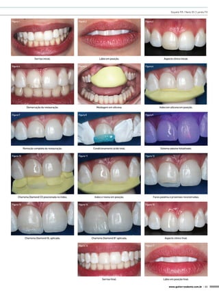 Goyatá FR / Neto OI / Landa FV


Figura 1                                         Figura 2                                    Figura 3




                     Sorriso inicial.                              Lábio em posição.                         Aspecto clínico inicial.

Figura 4                                         Figura 5                                    Figura 6




              Demarcação da restauração.                        Moldagem em silicona.                    Index em silicona em posição.

Figura 7                                         Figura 8                                    Figura 9




            Remoção completa da restauração.                  Condicionamento ácido total.                Sistema adesivo fotoativado.

Figura 10                                        Figura 11                                   Figura 12




     Charisma Diamond CO posicionada no índex.                 Index e resina em posição.           Faces palatina e proximais reconstruídas.

Figura 13                                        Figura 14                                   Figura 15




             Charisma Diamond OL aplicada.                   Charisma Diamond B1 aplicada.                    Aspecto clínico final.

                                                 Figura 16                                   Figura 17




                                                                     Sorriso final.                          Lábio em posição final.

                                                                                                                  www.gutierreodonto.com.br > 33
 