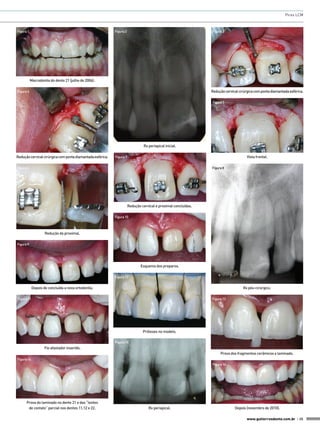 Pires LCM



Figura 1                                                    Figura 2                                             Figura 3




           Macrodontia do dente 21 (julho de 2006).

Figura 4                                                                                                         Redução cervical cirúrgica com ponta diamantada esférica.

                                                                                                                 Figura 5




                                                                                Rx periapical inicial.

Redução cervical cirúrgica com ponta diamantada esférica.   Figura 7                                                                   Vista frontal.

Figura 6                                                                                                         Figura 8




                                                                       Redução cervical e proximal concluídas.

                                                            Figura 10



                    Redução da proximal.

Figura 9




                                                                               Esquema dos preparos.

                                                            Figura 12


            Depois de concluída a nova ortodontia.                                                                                  Rx pós-cirúrgico.

Figura 11                                                                                                        Figura 13




                                                                                Próteses no modelo.

                                                            Figura 15
                    Fio afastador inserido.
                                                                                                                      Prova dos fragmentos cerâmicos e laminado.
Figura 14
                                                                                                                 Figura 16




      Prova do laminado no dente 21 e das “lentes
       de contato” parcial nos dentes 11,12 e 22.                                  Rx periapical.                              Depois (novembro de 2010).

                                                                                                                                       www.gutierreodonto.com.br > 35
 