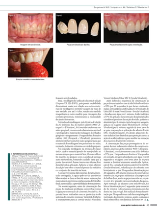 Bergamaschi NLG / Junqueira Jr. AA / Galafassi D / Mandarino F



Figura 1                                            Figura 2                                                Figura 3




               Imagem intraoral inicial.                        Peças em dissilicato de lítio.                     Peças imediatamente após cimentação.

Figura 4




           Função e estética reestabelecidas.




                                                    ficassem arredondados.                                  Veneer Medium Value MV 0 (IvoclarVivadent).
                                                       Para a moldagem foi utilizado silicone de adição         Após definida a sequência de cimentação, as
                                                    (Express XT, 3M-ESPE), pois possui estabilidade         peças foram tratadas com ácido hidrofluoridrico
                                                    dimensional maior em relação aos outros mate-           a 10% por 20 segundos, já que foram confeccio-
                                                    riais de moldagem e permite vazagem de mais de          nadas com cerâmica reforçada por Dissilicato de
                                                    um modelo por até 14 dias, sendo um modelo              Lítio (IPS E-max Press/Ceram – IvoclarVivadent)
                                                    troquelizado e outro modelo para checagem dos           e lavadas com água por 1 minuto. Ácido fosfórico
                                                    contatos proximais, minimizando a necessidade           a 37% foi aplicado para remoção dos precipitados
                                                    de ajustes intraorais.                                  cristalinos (produtos da reação do sódio, potássio e
                                                       Foi realizada moldagem pela técnica de duplo         alumínio) por 1 minuto. Após lavagem e secagem,
                                                    fio. O primeiro fio, de menor calibre (#000 Ul-         aplicou-se o agente silano Monobond S (Ivoclar-
                                                    trapack – Ultradent), foi inserido totalmente no        Vivadent) por 1 minuto, seguido de leves jatos de
                                                    sulco gengival, promovendo afastamento vertical         ar para evaporação e aplicação do adesivo Excite
                                                    e protegendo o material de moldagem dos fluidos         DSC (IvoclarVivadent). Os dentes adjacentes fo-
                                                    gengivais e sangramento. O segundo fio, de maior        ram isolados com fita teflon para proteção contra a
                                                    calibre (#00 Ultrapack – Ultradent), promoveu           ação do acido fosfórico e para auxiliar na remoção
                                                    afastamento horizontal do sulco gengival para que       dos excessos de cimento resinoso.
                                                    o material de moldagem leve penetrasse no sulco,           A cimentação das peças prosseguiu-se da se-
                                                    copiando fielmente o término cervical do preparo.       guinte forma: isolamento relativo do campo ope-
                                                       Foi realizada moldagem na técnica de passo           ratório, inserção do fio retrator #000 (Ultrapack-
                                                    único, onde o material pesado foi manipulado ao         -Ultradent), condicionamento com ácido fosfórico
   ◗◗ REFERÊNCIAS BIBLIOGRÁFICAS                    mesmo tempo que o material leve. O material leve        a 37% por 15 segundos em dentina e 30 segundos
   1) Magne P, Magne M. Treatmentofextended
   anterior crownfracturesusingType III A
                                                    foi inserido no preparo com o auxílio de seringa        em esmalte, lavagem abundante com água por 60
   bonded porcelainrestorations. J Calif Dent       auto misturadora, tomando cuidado para que a            segundos e secagem com leves jatos de ar para
   Assoc 2005;33:387-96.                            ponta descartável ficasse imersa no silicone leve       manter a dentina levemente umedecida. Aplica-
   2) GUESS, P. C.; STAPPERT, C. F.; STRUB,
   J. R. Preliminary clinical resultsof a
                                                    durante toda a aplicação. Aplicou-se mais silicone      ção de fina camada de sistema adesivo Excite DSC
   prospective study of IPS e.Max Press and         de adição leve sobre o material pesado da moldeira      (IvoclarVivadent), volatilização do solvente com
   CerecProCADpartial coverage crowns.              e o conjunto foi inserido na boca.                      leves jatos de ar por 20 segundos, fotoativação por
   SchweizMonatsschrZahnmed, Bern,v. 116,
   no. 5, p. 493-500, 2006.                             Coroas provisórias laboratoriais foram cimen-       20 segundos. O Cimento resinoso foi inserido no
   3) STAPPERT, C. F.; ATT, W.; GERDS, T.;          tadas em seguida. A opção pelo uso de provisórias       interior das peças para minimizar a incorporação
   STRUB, J. R. Fracture resistanceof different     laboratoriais se deve ao fato de serem restaurações     de bolhas de ar, sendo as peças inseridas no prepa-
   partial coverage ceramic molar restorations:
   an invitro investigation. J Am Dent Assoc,       mais naturais e próximas esteticamente do trabalho      ro com leve pressão para acomodação das peças.
   Chicago, v. 137, no. 4, p. 514-522, Apr. 2006.   final, aumentando a previsibilidade do tratamento.      Após remoção de excessos com microbrush, foi
   4) BLATZ, M.; SADAN, A.; KERN, M. Resin              Na sessão seguinte, antes da cimentação das         feita a fotoativação por 5 segundos para remoção
   ceramic bonding: a reviewof the literature.
   J Prosthet Dent, St. Louis, v. 89, no. 3, p.     peças, foi realizada profilaxia com pedra pomes         do fio retrator e dos excessos proximais com fio
   268-274,2003.                                    e água para remoção de cimento provisório. As           dental na fase pré-gel. Foi realizada fotopolimeri-
   5) KNOBLOCH, LA, Kerby RE, Seghi R,              provas foram realizadas com as pastas try-in do         zação por 20 segundos em cada facecompleta poli-
   Berlin JS,Lee JS. Fracture toughness of
   resin-based lutingcements. J Prosthet Dent.      sistema de cimento resinoso Variolink Esthetic          merização do cimento resinoso, sendo os excessos
   2000;83:204-9.                                   II transparente para as coroas totais e Variolink       finais removidos com lâminas de bisturi nº 12. 

                                                                                                                                www.gutierreodonto.com.br > 37
 
