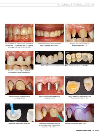 Fernandes RM / Nakao EM / Saito LMS / Matsumoto W / Moro DAP




Figura 1                                                  Figura 2                                                Figura 3




Fase inicial. Dente 12, resina composta extensa, faceta        Sorriso evidenciando as desproporções em                       Preparos para as peças cerâmicas
 direta no dente 11, provisória no dente 21, provisória            altura e largura do dente 12 ao 23.                           adesivas nos dentes 12 e 11.
     sobre implante Conexão HE 3,3 no dente 22.



Figura 4                                                  Figura 5                                                Figura 6




                                                                      Peças protéticas: coroa e laminado cerâmico E.Max Press e coroas de Zr Lava 3M ESPE.



     Prova das estruturas de Zr Lava 3M ESPE,
     conectadas para o molde de transferência.



Figura 7                                                  Figura 8                                                Figura 9




       Aspecto clínico favorável para a fixação                  Aspecto clínico favorável para a fixação             Preparo da superfície das peças com E.Max
               das peças protéticas.                                     das peças protéticas.                             Press, ácido fluorídrico por 20s.




Figura 10                                                 Figura 11                                               Figura 12




      Aplicação do silano, ceramic primer 3M.                   Tratamento do remanescente, aplicação            Iniciando a fixação pelos dentes 11 e 21.
                                                                 do adesivo DSC (Ivoclar Vivadent) após
                                                                      ataque com ácido fosfórico.

                                                                                                                                        www.gutierreodonto.com.br > 43
 