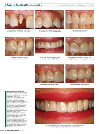  Caderno Científico | Reabilitação Oral                                                             Fernandes RM / Nakao EM / Saito LMS / Matsumoto W / Moro DAP




 Figura 13                                              Figura 14                                                Figura 15




       Aspecto após a aplicação do adesivo DSC               Após a pré-polimerização da coroa de Zr                           Logo após a fixação e remoção
    (Ivoclar Vivadent), posterior ao ácido fosfórico.       Lava 3M ESPE, com cimento U100 3M ESPE.                              dos excessos de cimento.




 Figura 16                                              Figura 17                                                Figura 18




              Logo após a fixação e remoção                     Sorriso final, após a fixação das peças               Controle após três anos de instalação., com
                dos excessos de cimento.                            protéticas do dente 12 ao 23.                excelente qualidade das margens gengivais e papilas.




                                                        Figura 19                                                Figura 20




                                                                    Controle após três anos de fixação.                      Controle após três anos de fixação.



                                                         Figura 21
     ◗◗ Referências Bibliográficas
     1) Fradeani M, Barducci G. Uma abordagem
     sistemática à integração estética, biológica e
     funcional. Tradução Rosseti PHO. São Paulo:
     Quintessence, 2009, p26-120.
     2) Myashita E, Marchezi M, Salfatis M,
     Mesquita AMM, Souza RO. Plano de
     tratamento integrado em reabilitação
     oral. In: Reabilitação oral previsibilidade e
     longevidade. Napoleão Editora, 2011,p25-83.
     3) Grunder U, Gracis S, Capelli M. Influence
     of the 3-D bone-to-import relationship on
     esthetics. Int J Periodontics Restorative
     Dent, 2005 apr,,25(2):113-9.
     4) Della Bona A. Adesão às cerâmicas:
     evidências científicas para o uso clínico. Ed
     Artes Médicas, 2009, p43-90.
     5) BEIER US, KAPFERER I, BURTSCHER
     D, DUMFAHRT H. Clinical Performance of
     Porcelain Veneers for up to 20 year. Int J.
     Prosthod 2012 fev;25(1):79-85.
     6) Tortamano Neto P, Kanashiro LH, Camargo
     LOA. Estudo e seleção dos componentes
     protéticos. Quintessence Editora, 2001,p129-149.
     7) GUESS PC, SCHUTHEIS S, BONFANTE
     EA, COELHO PG, FERENCZ JL, SILVA NR.
     All ceamic systems: laboratory and clinical
     performance. Dent Clin North Am 2011                                     Sorriso remodelado após três anos de controle. Tratamento executado
     Abr;55(2):333-52.                                                              no Curso de Especialização em Prótese Dentária da Aorp.

44 > Revista Gutierre Odontolife - EDIÇÃO 53
 
