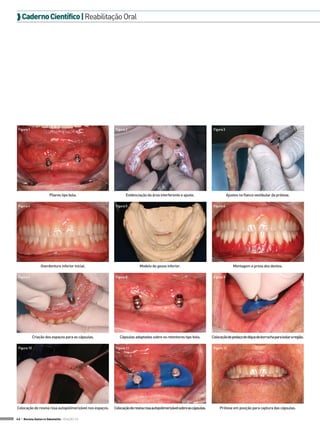  Caderno Científico | Reabilitação Oral




 Figura 1                                                  Figura 2                                                        Figura 3




                       Pilares tipo bola.                        Evidenciação da área interferente e ajuste.                          Ajustes no flanco vestibular da prótese.

 Figura 4                                                  Figura 5                                                        Figura 6




                  Overdenture inferior inicial.                           Modelo de gesso inferior.                                       Montagem e prova dos dentes.

 Figura 7                                                  Figura 8                                                        Figura 9




             Criação dos espaços para as cápsulas.           Cápsulas adaptadas sobre os retentores tipo bola.            Colocação de pedaço de dique de borracha para isolar a região.

 Figura 10                                                 Figura 11                                                       Figura 12




Colocação de resina rosa autopolimerizável nos espaços.   Colocação de resina rosa autopolimerizável sobre as cápsulas.        Prótese em posição para captura das cápsulas.

46 > Revista Gutierre Odontolife - EDIÇÃO 53
 