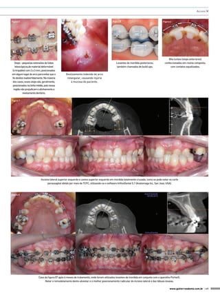 Accorsi M


Figura 3                                    Figura 4                                    Figura 5                                    Figura 6




                                                                                                                                         Bite turbos (stops anteriores)
  Stops - pequenas extensões de tubos                                                      Levantes de mordida posteriores,           confeccionados em resina composta,
  telescópicos,de material deformável                                                      também chamados de build ups.                   com contatos equalizados.
(crimpable) com 2 a 3 mm, posicionados
em algum lugar do arco para evitar que o       Deslizamento indevido do arco
fio deslize inadvertidamente. Na maioria        retangular, causando injúria
dos casos, esses stops são, geralmente,            à mucosa do paciente.
 posicionados na linha média, pois nessa
 região não prejudicam o alinhamento e
          nivelamento dentário.

Figura 7




                          Incisivo lateral superior esquerdo e canino superior esquerdo em mordida totalmente cruzada, como se pode notar no corte
                                 parassagital obtido por meio de TCFC, utilizando-se o software InVivoDental 5.1 (Anatomage Inc, San Jose, USA).



Figura 8




                        Caso da figura 07 após 6 meses de tratamento, onde foram utilizados levantes de mordida em conjunto com o aparelho Portia®.
                             Notar o remodelamento dento-alveolar e o melhor posicionamento radicular do incisivo lateral e das tábuas ósseas.

                                                                                                                                          www.gutierreodonto.com.br > 49
 