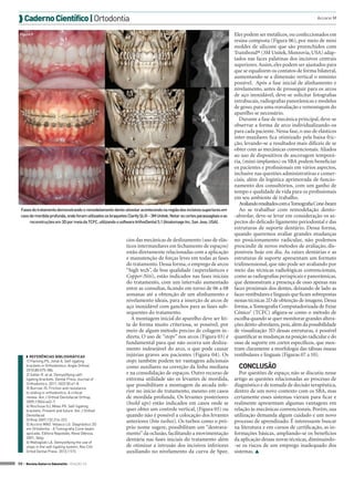  Caderno Científico | Ortodontia                                                                                                                                    Accorsi M


 Figura 9                                                                                                                   Eles podem ser metálicos, ou confeccionados em
                                                                                                                            resina composta (Figura 06), por meio de mini
                                                                                                                            moldes de silicone que são preenchidos com
                                                                                                                            Transbond® (3M Unitek, Monrovia, USA) adap-
                                                                                                                            tados nas faces palatinas dos incisivos centrais
                                                                                                                            superiores. Assim, eles podem ser ajustados para
                                                                                                                            que se equalizem os contatos de forma bilateral,
                                                                                                                            aumentando-se a dimensão vertical o mínimo
                                                                                                                            possível. Após a fase inicial de alinhamento e
                                                                                                                            nivelamento, antes de prosseguir para os arcos
                                                                                                                            de aço inoxidável, deve-se solicitar fotografias
                                                                                                                            intrabucais, radiografias panorâmicas e modelos
                                                                                                                            de gesso, para uma reavaliação e remontagem do
                                                                                                                            aparelho se necessário.
                                                                                                                               Durante a fase de mecânica principal, deve-se
                                                                                                                            observar a forma de arco individualizando-os
                                                                                                                            para cada paciente. Nessa fase, o uso de elásticos
                                                                                                                            inter-maxilares fica otimizado pela baixa fric-
                                                                                                                            ção, levando-se a resultados mais difíceis de se
                                                                                                                            obter com as mecânicas convencionais. Aliados
                                                                                                                            ao uso de dispositivos de ancoragem temporá-
                                                                                                                            ria, (mini-implantes) os SBA podem beneficiar
                                                                                                                            os pacientes e profissionais em vários aspectos,
                                                                                                                            inclusive nas questões administrativas e comer-
                                                                                                                            ciais, além da logística aprimorada de funcio-
                                                                                                                            namento dos consultórios, com um ganho de
                                                                                                                            tempo e qualidade de vida para os profissionais
                                                                                                                            em seu ambiente de trabalho.
                                                                                                                               Avaliando resultados com a Tomografia Cone-beam
 Fases do tratamento demonstrando o remodelamento dento-alveolar acontecendo na região dos incisivos superiores em             Ao se trabalhar com remodelação dento-
 caso de mordida profunda, onde foram utilizados os braquetes Clarity SL® - 3M Unitek. Notar os cortes parassagitais e as   -alveolar, deve-se levar em consideração os as-
      reconstruções em 3D por meia da TCFC, utilizando o software InVivoDental 5.1 (Anatomage Inc, San Jose, USA).          pectos do delicado ligamento periodontal e das
                                                                                                                            estruturas de suporte dentário. Dessa forma,
                                                                                                                            quando queremos avaliar grandes mudanças
                                                              cios das mecânicas de deslizamento (uso de elás-              no posicionamento radicular, não podemos
                                                              ticos intermaxilares em fechamento de espaços)                prescindir de novos métodos de avaliação, dis-
                                                              estão diretamente relacionadas com a aplicação                poníveis hoje em dia. As raízes dentárias e as
                                                              e manutenção de forças leves em todas as fases                estruturas de suporte apresentam um formato
                                                              do tratamento. Dessa forma, o emprego de arcos                tridimensional, que não pode ser avaliando por
                                                              “high tech”, de boa qualidade (superelásticos e               meio das técnicas radiológicas convencionais,
                                                              Copper-Niti), estão indicados nas fases iniciais              como as radiografias periapicais e panorâmicas,
                                                              do tratamento, com um intervalo aumentado                     que demonstram a presença de osso apenas nas
                                                              entre as consultas, ficando em torno de 06 a 08               faces proximais dos dentes, deixando de lado as
                                                              semanas até a obtenção de um alinhamento e                    faces vestibulares e linguais que ficam sobrepostas
                                                              nivelamento ideais, para a inserção de arcos de               nessas técnicas 2D de obtenção de imagens. Dessa
                                                              aço inoxidável com ganchos para as fases sub-                 forma, a Tomografia Computadorizada de Feixe
                                                              sequentes do tratamento.                                      Cônico5 (TCFC) afigura-se como o método de
                                                                 A montagem inicial do aparelho deve ser fei-               escolha quando se quer monitorar grandes altera-
                                                              ta de forma muito criteriosa, se possível, por                ções dento-alveolares, pois, além da possibilidade
                                                              meio de algum método preciso de colagem in-                   de visualização 3D dessas estruturas, é possível
                                                              direta. O uso de “stops” nos arcos (Figura 03) é              quantificar as mudanças na posição radicular e do
                                                              fundamental para que não ocorra um desliza-                   osso de suporte em cortes específicos, que mos-
                                                              mento indesejável do arco, o que pode causar                  tram claramente a morfologia das tábuas ósseas
     ◗ REFERÊNCIAS BIBLIOGRÁFICAS                             injúrias graves aos pacientes (Figura 04). Os                 vestibulares e linguais (Figuras 07 a 10).
     1) Fleming PS, Johal A. Self-ligating                    stops também podem ter vantagens adicionais
     brackets in Orthodontics. Angle Orthod.
     2010;80:575-584.
                                                              como auxiliares na correção da linha mediana                    CONCLUSÃO
     2) Satler R. et al. Demystifying self-                   e na consolidação de espaços. Outro recurso de                   Por questões de espaço, não se discutiu nesse
     ligating brackets. Dental Press Journal of               extrema utilidade são os levantes de mordida,                 artigo as questões relacionadas ao processo de
     Orthodontics. 2011;16(2):50.e1-8.                        que possibilitam a montagem da arcada infe-                   diagnóstico e de tomada de decisão terapêutica,
     3) Burrow JS. Friction and resistance
     to sliding in orthodontics: A critical                   rior no início do tratamento, mesmo em casos                  dentro de um novo contexto com os SBA, mas
     review. Am J Orthod Dentofacial Orthop.                  de mordida profunda. Os levantes posteriores                  certamente esses sistemas vieram para ficar e
     2009;135(4):442-7.                                       (build ups) estão indicados em casos onde se                  realmente apresentam algumas vantagens em
     4) Rinchuse DJ, Miles PG. Self-ligating
     brackets: Present and future. Am J Orthod                quer obter um controle vertical, (Figura 05) ou               relação às mecânicas convencionais. Porém, sua
     Dentofacial                                              quando não é possível a colocação dos levantes                utilização demanda algum cuidado e um novo
     Orthop 2007;132:216-222.                                 anteriores (bite turbos). Os turbos como o pró-               processo de aprendizado. É interessante buscar
     5) Accorsi MAO. Velasco LG. Diagnóstico 3D
     em Ortodontia - A Tomografia Cone-beam                   prio nome sugere, possibilitam um “destrava-                  na literatura e em cursos de certificação, as in-
     aplicada. Editora Napoleão, Nova Odessa,                 mento” da oclusão, facilitando a movimentação                 formações básicas, ampliando-se os benefícios
     2001, 364p.                                              dentária nas fases iniciais do tratamento além                da aplicação dessas novas técnicas, diminuindo-
     6) Maltagliati LA. Demystifying the use of
     stops in the self-ligating system, Rev Clín              de otimizar a intrusão dos incisivos inferiores               -se os riscos de um emprego inadequado dos
     Ortod Dental Press. 2012;11(1).                          auxiliando no nivelamento da curva de Spee.                   sistemas. 

50 > Revista Gutierre Odontolife - EDIÇÃO 53
 