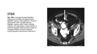 genitourinary trauma a radiology discussion | PPTX