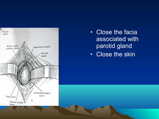 • Close the facia
  associated with
  parotid gland
• Close the skin
 