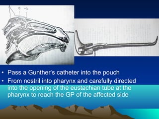 • Pass a Gunther’s catheter into the pouch
• From nostril into pharynx and carefully directed
  into the opening of the eustachian tube at the
  pharynx to reach the GP of the affected side
 