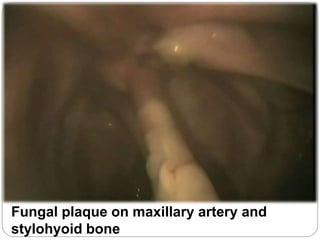 Fungal plaque on maxillary artery and
stylohyoid bone
 