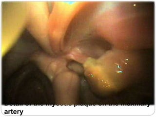 Detail of the mycotic plaque on the maxillary
artery
 