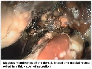 Mucous membranes of the dorsal, lateral and medial recess
veiled in a thick coat of secretion
 