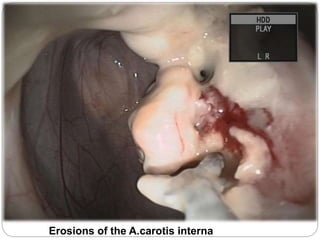 Erosions of the A.carotis interna
 