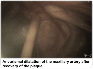 Aneurismal dilatation of the maxillary artery after
recovery of the plaque
 
