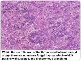 Within the necrotic wall of the thrombosed internal carotid
artery, there are numerous fungal hyphae which exhibit
parallel walls, septae, and dichotomous branching.
 