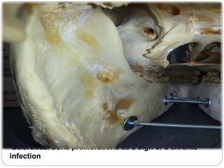 Sclerotical bone proliferations as a sign of a chronic
infection
 