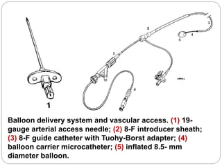 Balloon delivery system and vascular access. (1) 19-
gauge arterial access needle; (2) 8-F introducer sheath;
(3) 8-F guide catheter with Tuohy-Borst adapter; (4)
balloon carrier microcatheter; (5) inflated 8.5- mm
diameter balloon.
 