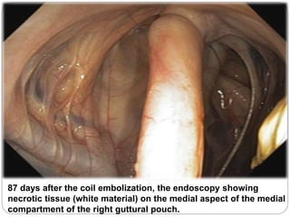 87 days after the coil embolization, the endoscopy showing
necrotic tissue (white material) on the medial aspect of the medial
compartment of the right guttural pouch.
 