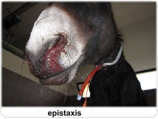 Bilateral
epistaxis
 
