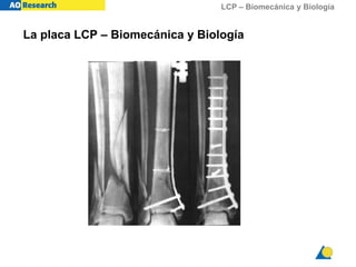 LCP – Biomecánica y Biología
La placa LCP – Biomecánica y Biología
 